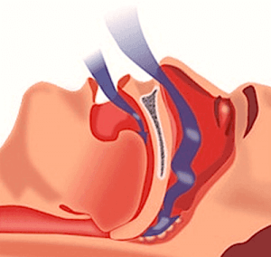 Radiofrequency Palatoplasty