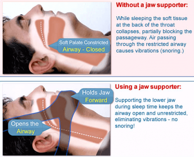 How Anti-Snoring Chinstrap Works