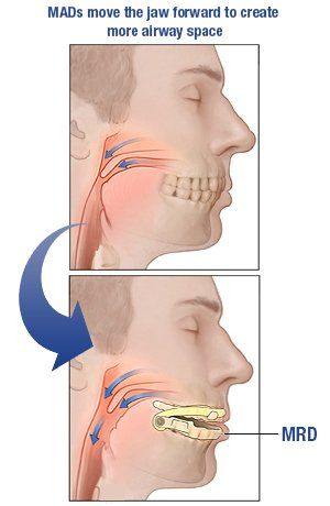 How MAD mouthpieces work
