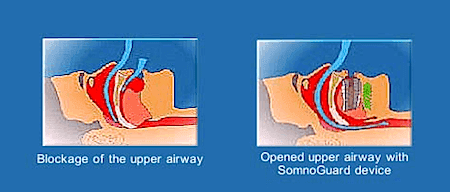 My Experience with SomnoGuard AP 2 - Best Mouthpiece for Men?