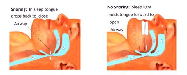 How SleepTight Mouthpiece Works
