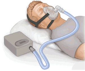 CPAP Device