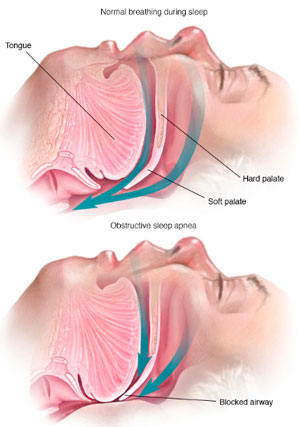 blocked airways result in sleep apnea
