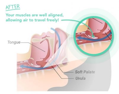 an open airway for less snoring