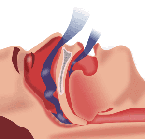 sleep apnea is caused by your tongue blocking breathing airflow