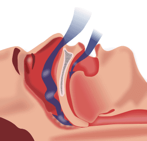 sleep apnea is caused by your tongue blocking breathing airflow