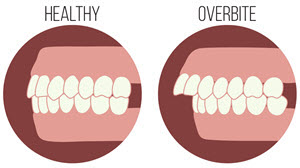 structure of an overbite