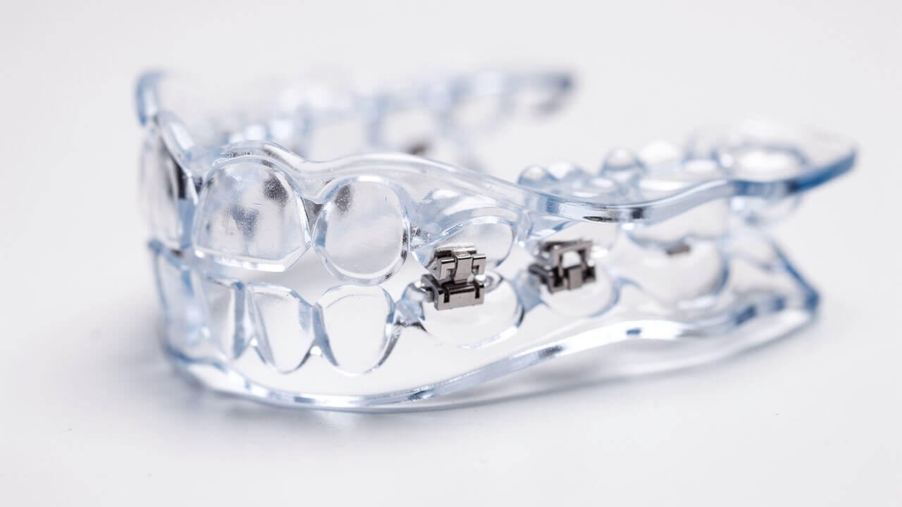 Clear mandibular advancement device for snoring