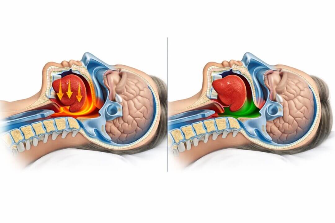 Detailed () medical illustration showing cross-sectional view of human head and neck in supine back sleeping position,