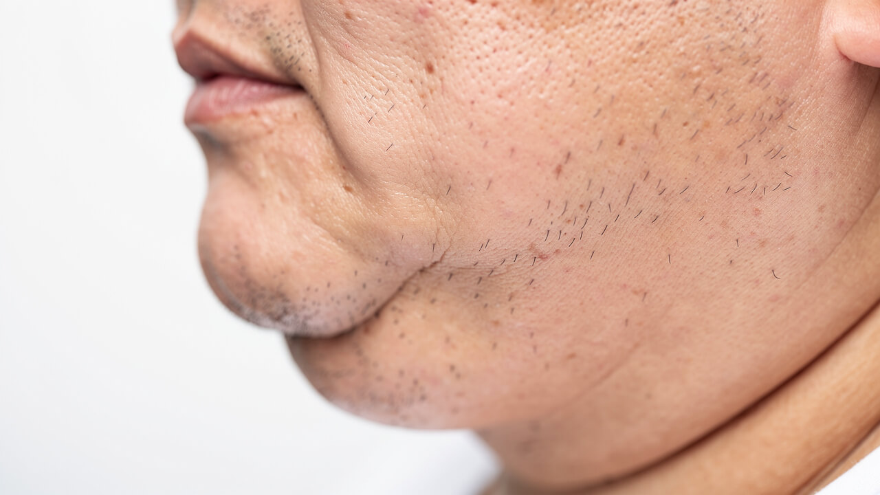 Close-up of overweight neck showing fatty tissue around throat